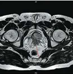 КТ или МРТ простаты: что лучше