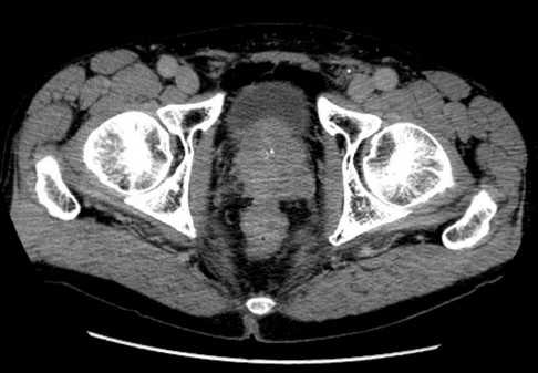 Область интереса на томограмме малого таза