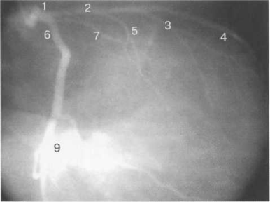 Левая коронарная артерия. Правая косая проекция.