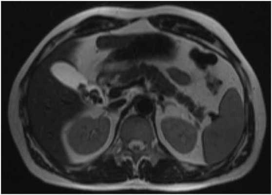 МРТ брюшной полости