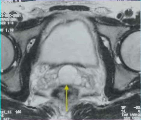 Лучевая диагностика заболеваний предстательной железы