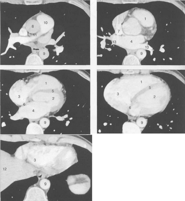 КТ сердца и сосудов.