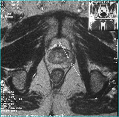 Лучевая диагностика заболеваний предстательной железы
