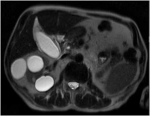 МРТ брюшной полости