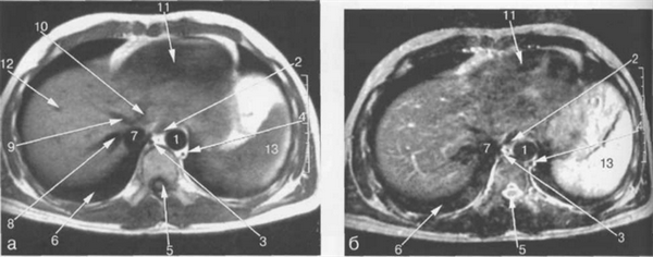 МРТ брюшной полости в аксиальной плоскости на уровне печеночных вен.