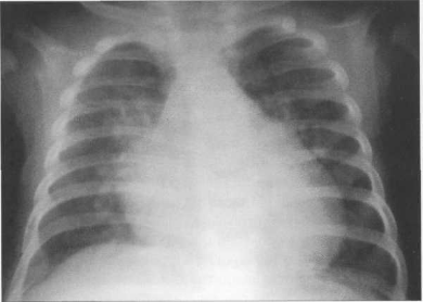Рентгенограмма грудной клетки ребенка 3 месяцев. Задняя проекция.
