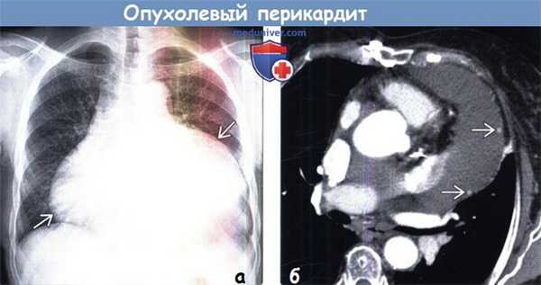 Опухолевый перикардит на рентгенограмме, КТ