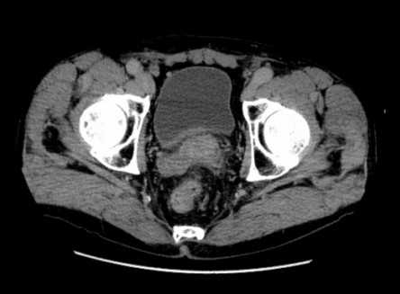 Лучевая диагностика заболеваний предстательной железы