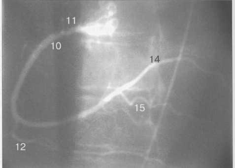 Правая коронарная артерия в переднезадней проекции.