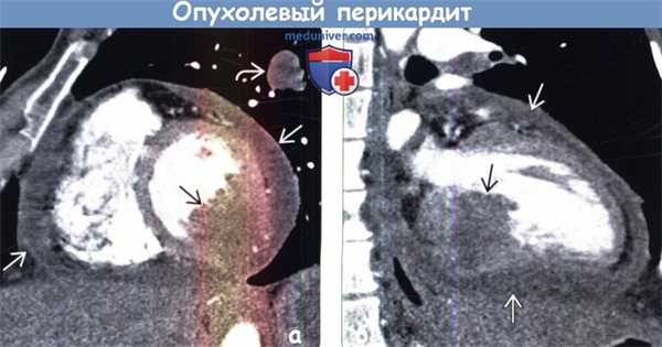 Опухолевый перикардит на КТ