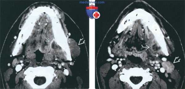 КТ при абсцессе жевательного пространства