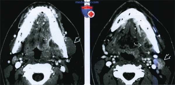 КТ, МРТ при абсцессе жевательного пространства