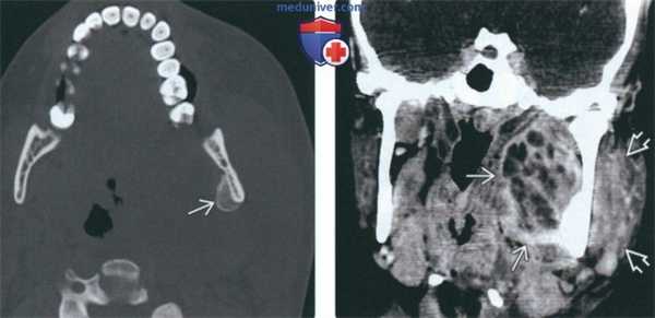 КТ при абсцессе жевательного пространства