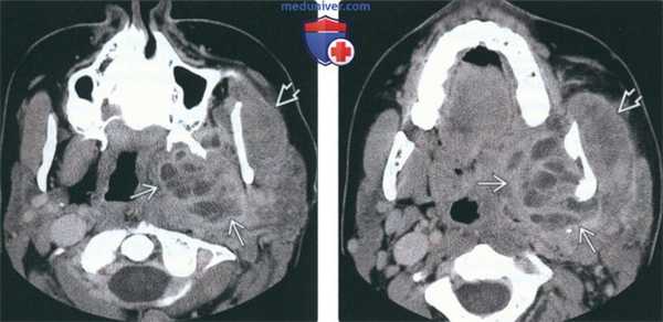 КТ при абсцессе жевательного пространства