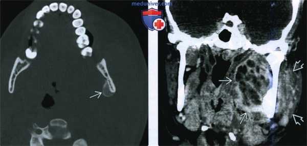 КТ, МРТ при абсцессе жевательного пространства