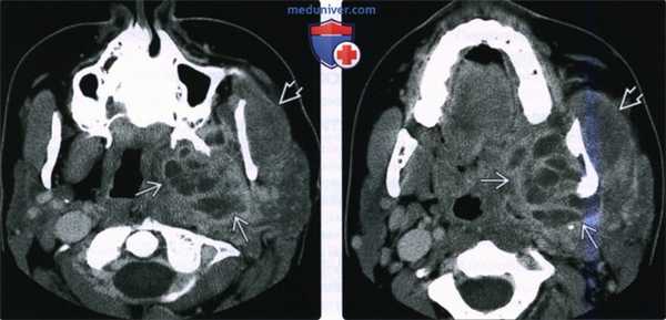 КТ, МРТ при абсцессе жевательного пространства