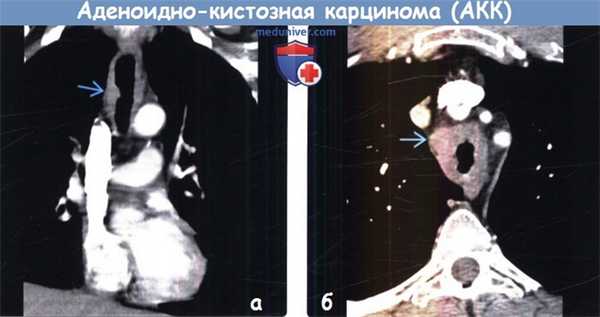 Аденоидно-кистозная карцинома трахеи, бронха на КТ