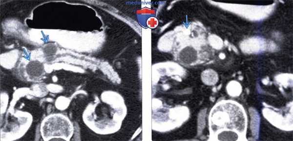 ЭРХПГ, КТ, МРТ, УЗИ признаки разделенной поджелудочной железы