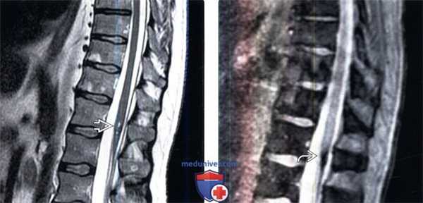 МРТ при кавернозной мальформации позвоночника