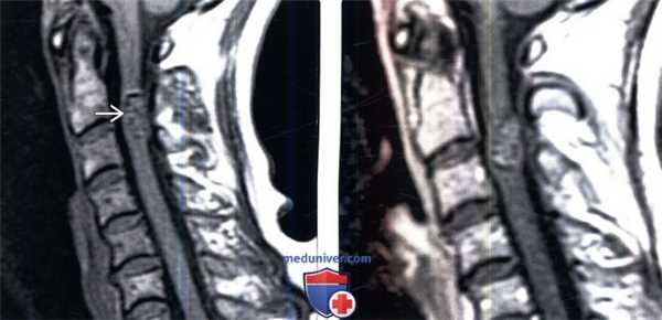 МРТ при кавернозной мальформации позвоночника