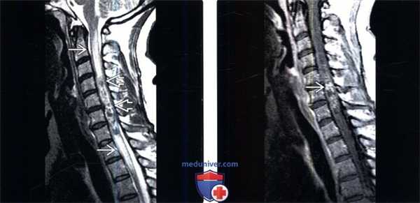 МРТ при кавернозной мальформации позвоночника