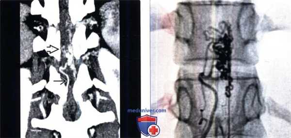 МРТ при сосудистой мальформации 4 типа позвоночника (артериовенозной фистуле, АВФ)