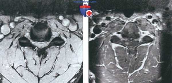 Рентгенограмма, КТ, МРТ при артрозе дугоотростчатых суставов шейных позвонков