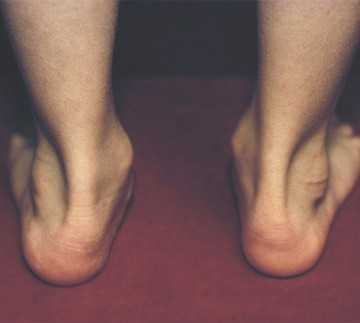 Фото Артроз дугоотросчатых суставов