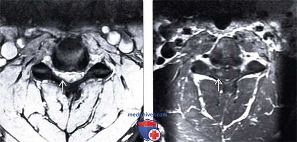 МРТ артропатии дугоотростчатых суставов шейного отдела позвоночника
