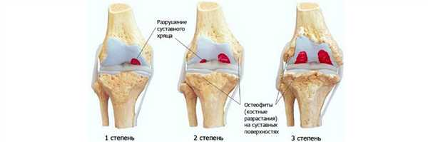 Стадии артроза