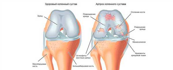 Артроз коленного сустава