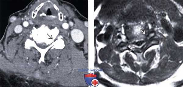 КТ, МРТ артропатии дугоотростчатых суставов шейного отдела позвоночника