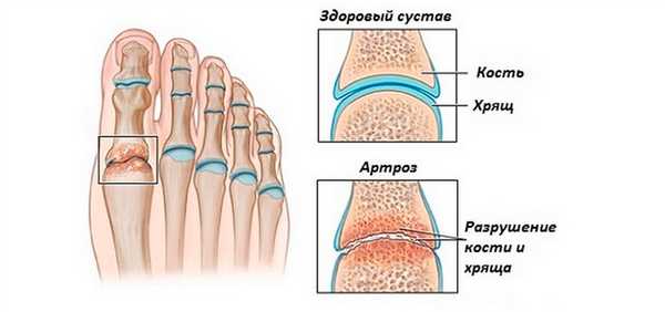 Артроз сустава стопы