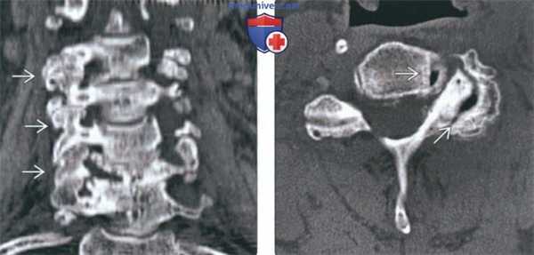 Рентгенограмма, КТ, МРТ при артрозе дугоотростчатых суставов шейных позвонков