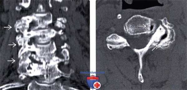 КТ, МРТ артропатии дугоотростчатых суставов шейного отдела позвоночника