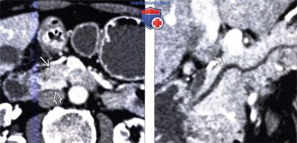 Лучевая диагностика ассиметричной жировой дольки поджелудочной железы