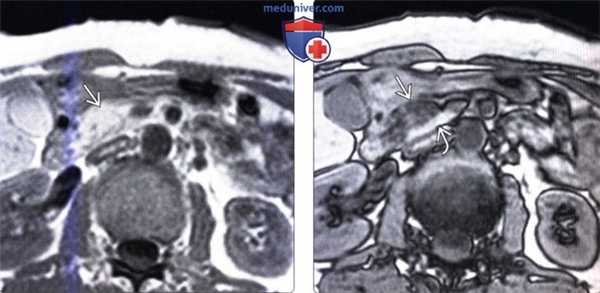 Лучевая диагностика ассиметричной жировой дольки поджелудочной железы