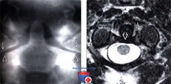 Рентгенограмма, КТ при переломе первого шейного позвонка (С1) Джефферсона