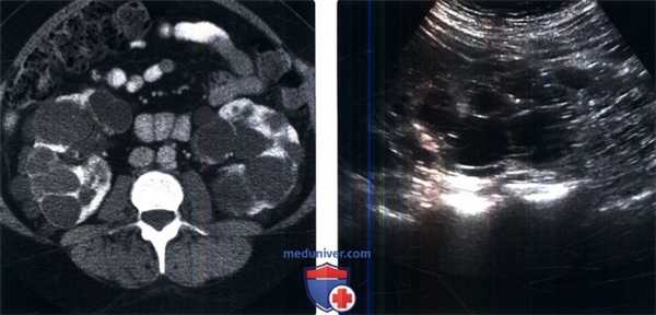 КТ, МРТ, УЗИ при аутосомно-доминантной поликистозной болезни почек
