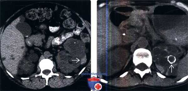 КТ, МРТ, УЗИ при аутосомно-доминантной поликистозной болезни почек
