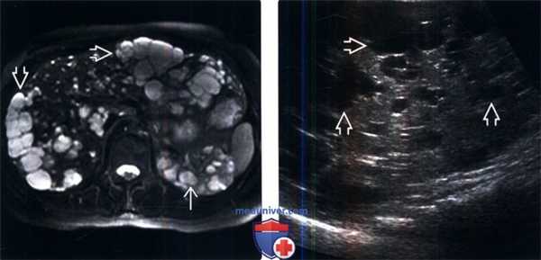 КТ, МРТ, УЗИ при аутосомно-доминантной поликистозной болезни почек