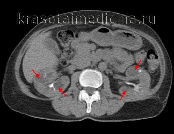 КТ ОБП и забрюшинного пространства. Множественные интрапаренхиматозные простые кисты обеих почек.