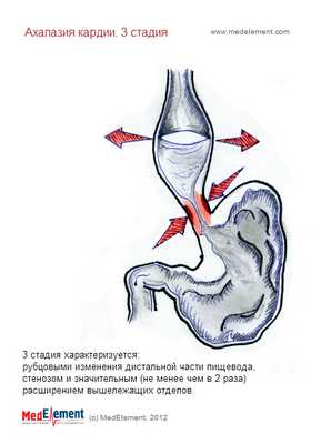 Ахалазия кардии. Классификация. 3-ая стадия развития