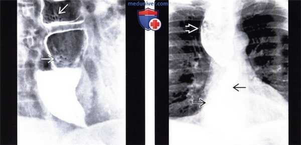 Рентгенограмма, КТ при ахалазии кардиального отдела пищевода