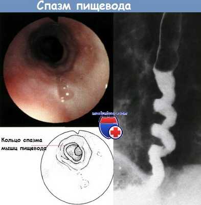 Спазм пищевода
