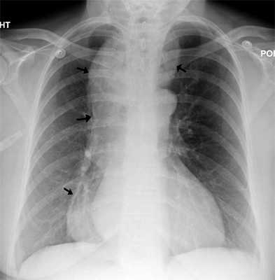 James Heilman, MD.A CXR showing achalasia (arrows point to the outline of the massively dilated esophagus).