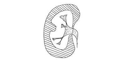 Схема: симптом конгруэнтности контуров паренхимы и чашечно-лоханочной системы почки при неполной