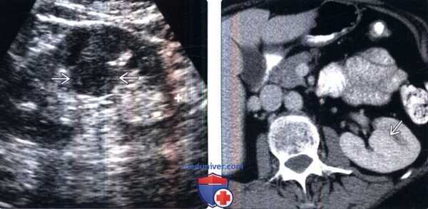 КТ, УЗИ при бертиниевых колоннах почки