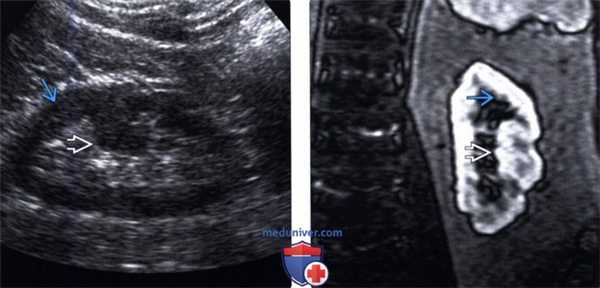УЗИ, МРТ бертиниевой колонны в почке