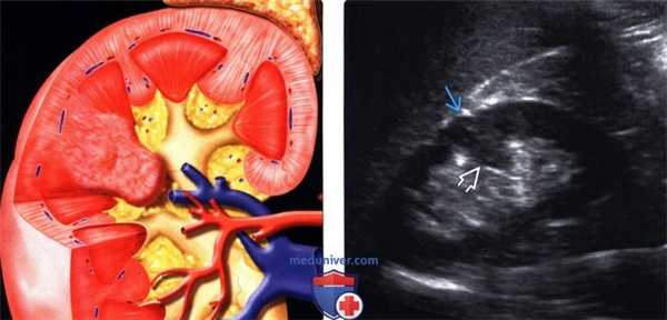 УЗИ, МРТ бертиниевой колонны в почке